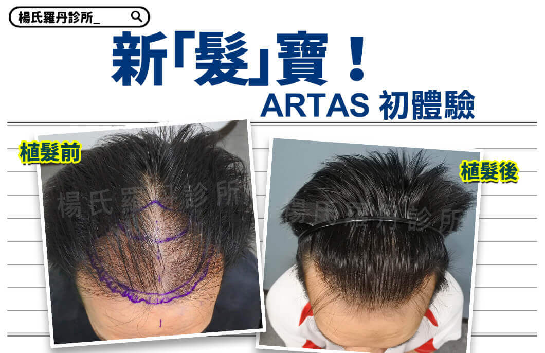 【植髮】植髮新「髮」寶！ARTAS系統植髮初體驗!